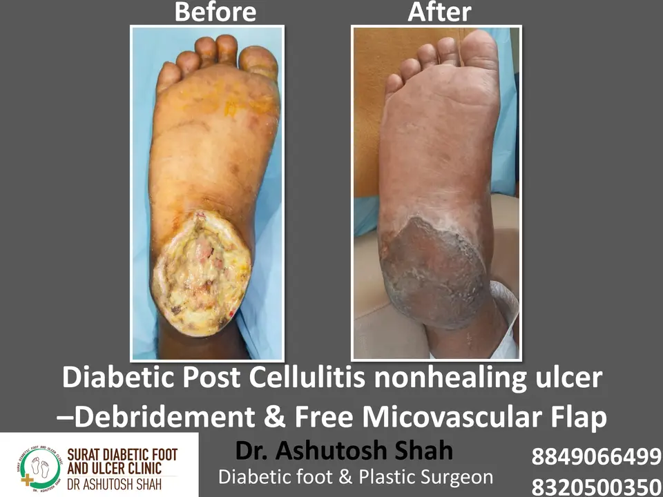 Diabetic Foot  PPT sunita.pptx-4.webp